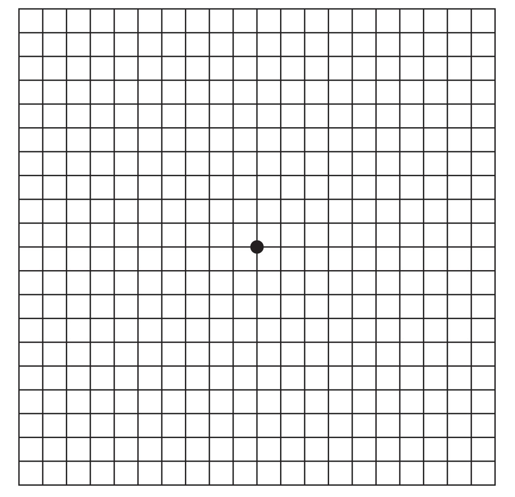 The Amsler grid is a tool that eye doctors use to detect vision problems resulting from damage to the macula or the optic nerve